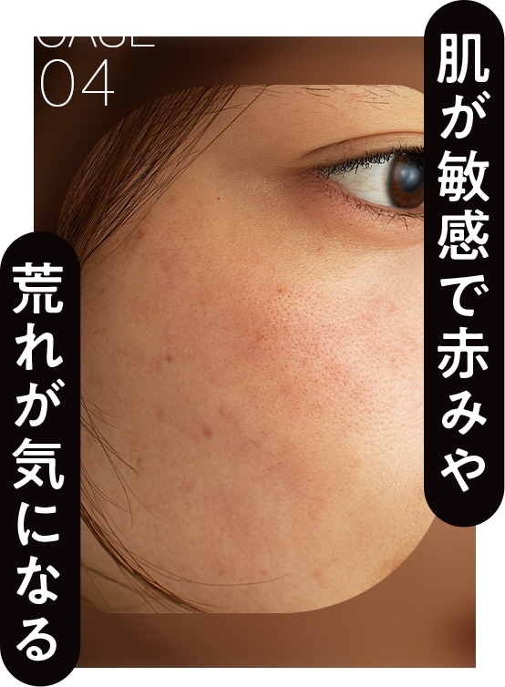 肌が敏感で赤みや荒れが気になる
